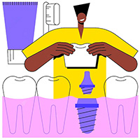 Dental Implants